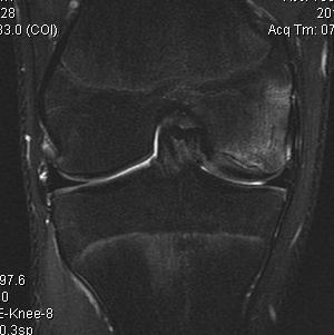 Femoral OCD Type 3 MRI